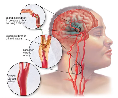 What are the 5 warning signs of a stroke?